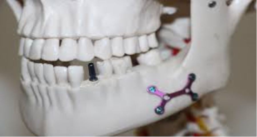 Yerli implant üretildi